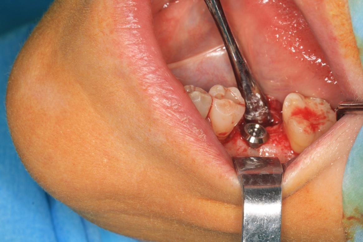 Implantología y cirugía oral - tratamiento en Clínica Sánchez-Campos